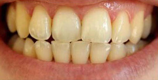 Teeth-whitening-01