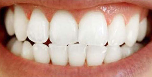 teeth-whitening-02