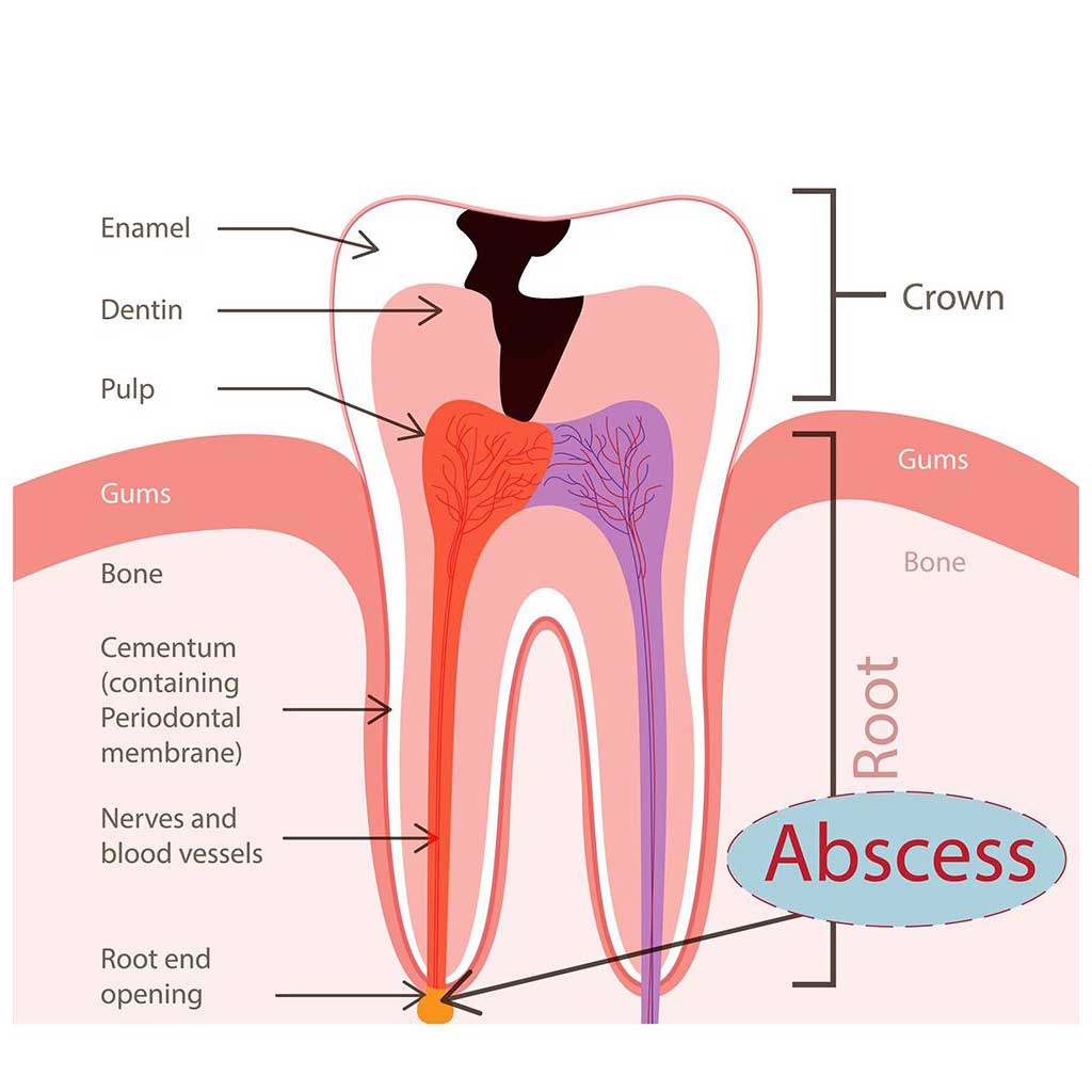 Root-Canal